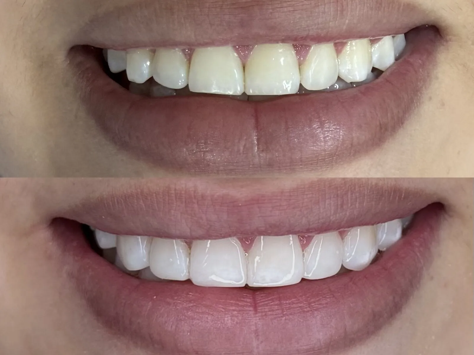 Antes y después de armonización dental